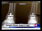 Rheumatoid Arthritis Ankle Replacement Surgery